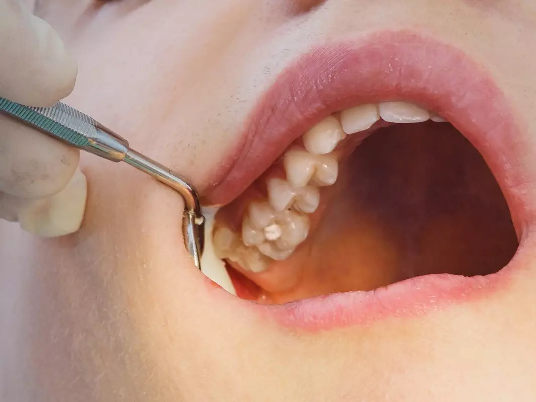 Restorative Fillings