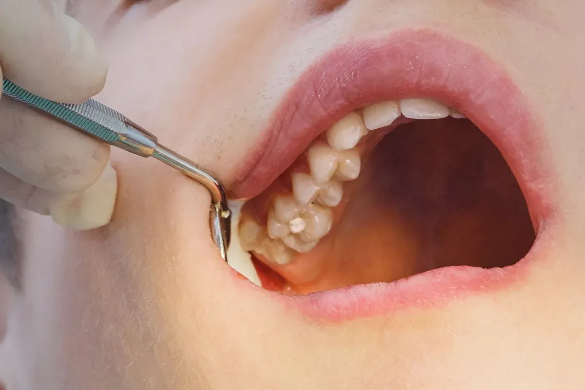 Restorative Fillings