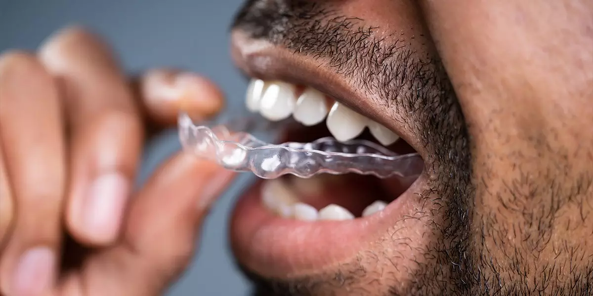 Park Street Dental | Quick Straight Teeth Treatment