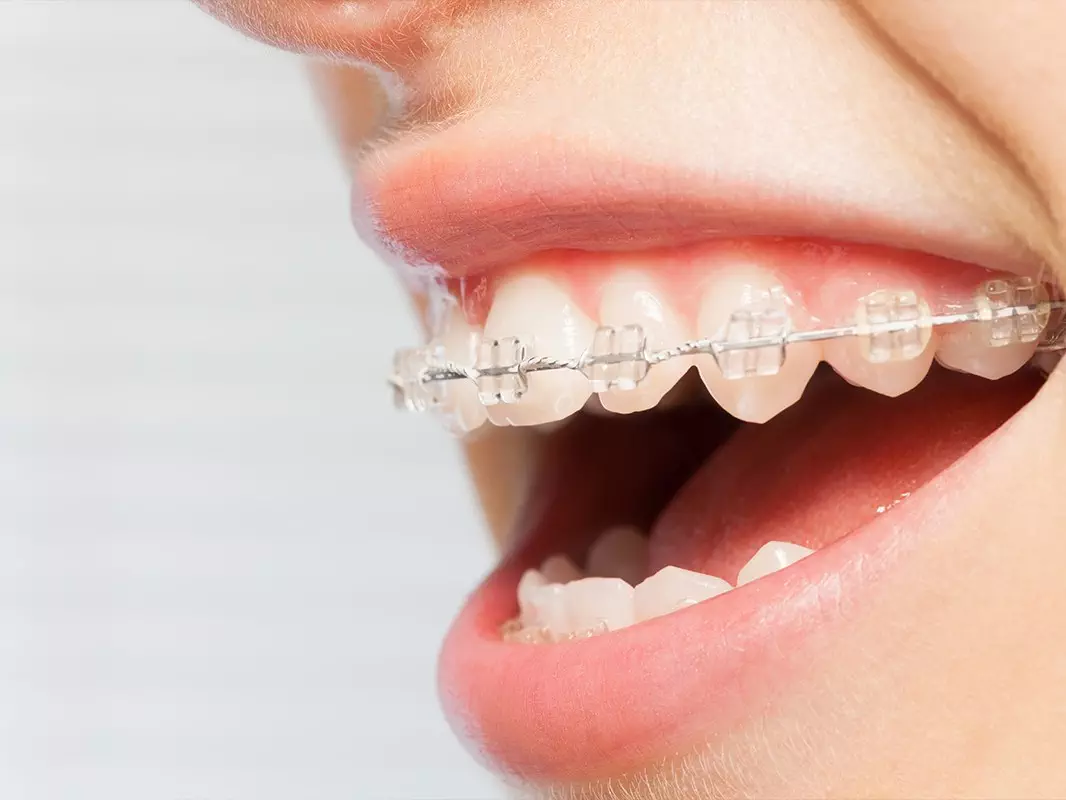 Quick Straight Teeth Treatment