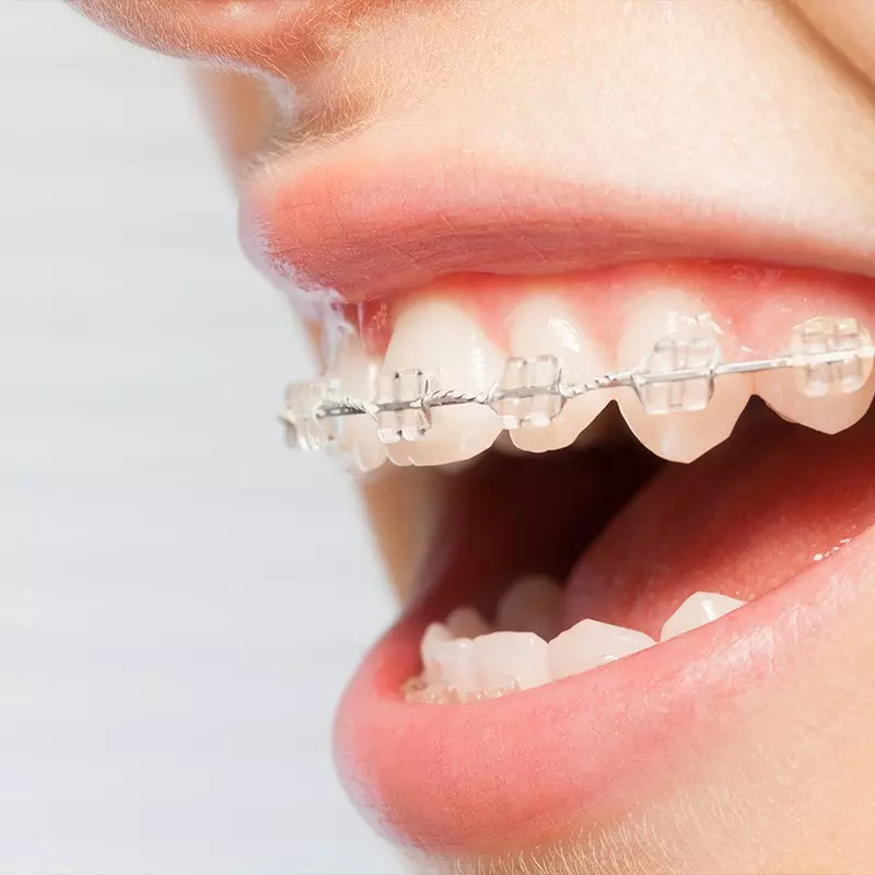 Quick Straight Teeth Treatment