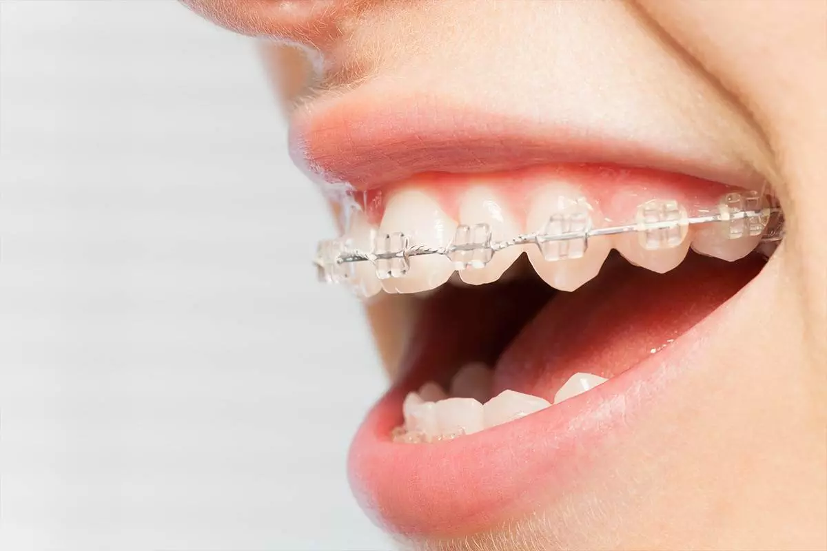 Quick Straight Teeth Treatment