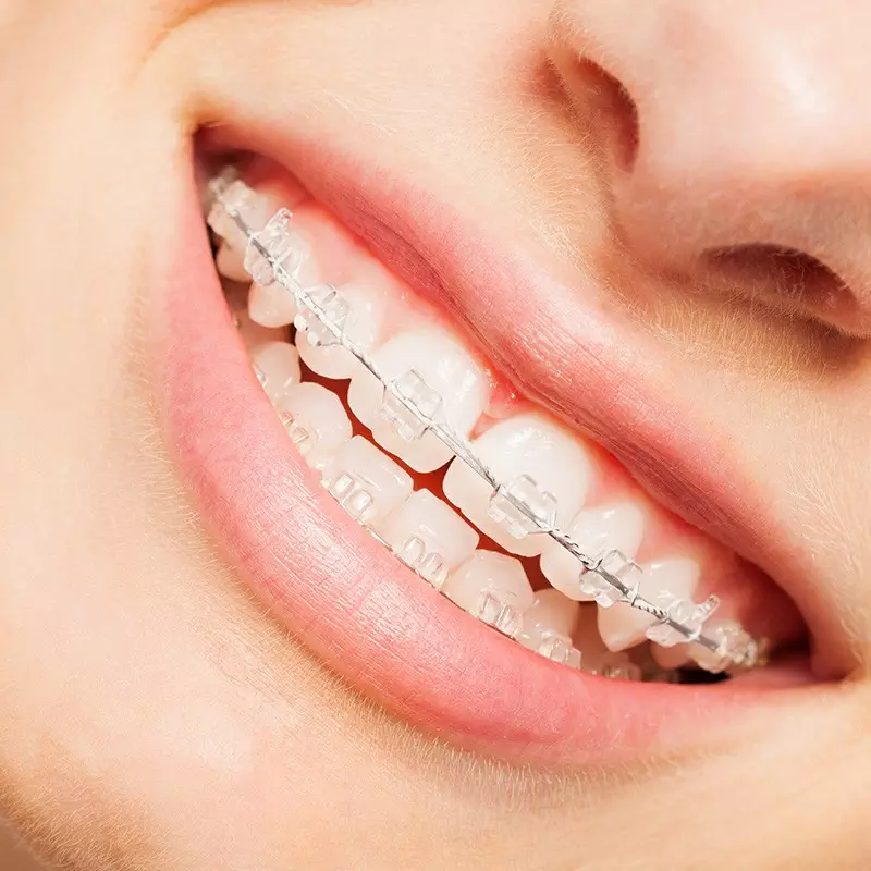 Park Street Dental | Quick Straight Teeth Treatment